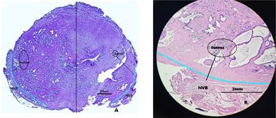 Indications for nerve-sparing surgery for radical prostatectomy: Results from a single-center study